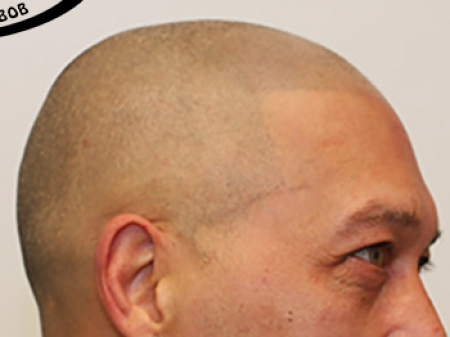 Micro Haar Pigmentatie is in de Verenigde Staten, ook wel bekend als Scalp Micropigmentation (SMP) of Scalp Pigmentation. In Nederland zult u veel het woord of de term 