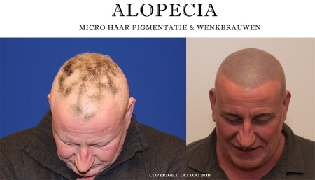 De geschoren look in plaats van Alopecia. Micro haar pigmentatie is de oplossing voor Alopecia