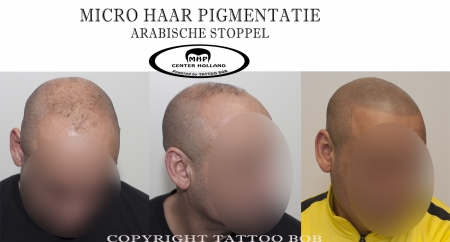 De techniek die door de meeste klinieken in Nederland en de rest van de wereld wordt gebruikt voor een micro haar pigmentatie behandeling, vinden wij bij Tattoo Bob nog niet het ultieme resultaat. Daarom heeft Tattoo Bob een unieke MHP-techniek ontwikkeld