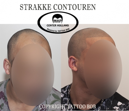 Micro Haar pigmentatie is de oplossing voor een strakke haarlijn