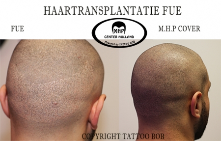 Bij FUE-haartransplantatietechnieken zullen er altijd minuscule littekentjes achterblijven. Wanneer er  sprake is van (meerdere) FUE-haartransplantaties met een groot aantal grafts en het haar van het donorgebied gemillimeterd wordt, zullen de littekentje