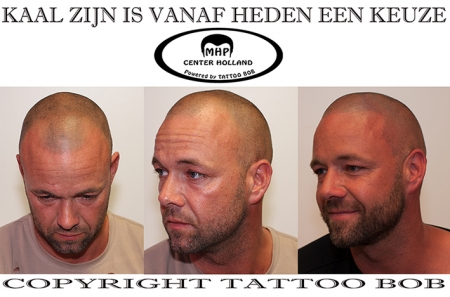 Het is onmogelijk om de micro haar pigmentatie ofwel stoppel tattoo met het blote oog waar te nemen.Daarom kiezen fotomodellen massaal voor deze behandeling