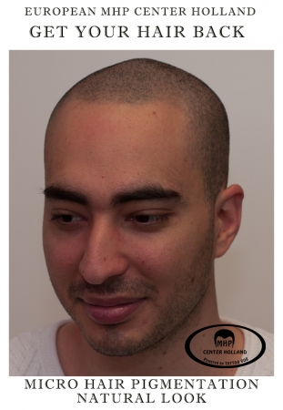 Realistische stoppels, de MHP methode kan gebruikt worden voor een mooie opvulling van het haar.