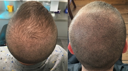 Micro haar pigmentatie, tegenwoordig ook wel bekend als de stoppel tattoo, is een perfecte oplossing voor mannen of vrouwen die last hebben van kaalheid, haaruitval, dun haar of alopecia. Bij de micro haar pigmentatie techniek (MHP) worden m.b.v. een uite