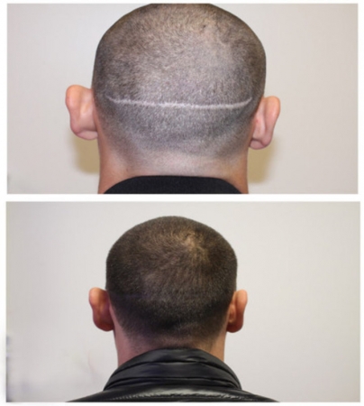 Met Micro Hair Pigmentation ( MHP ) is het goed mogelijk om het litteken op het achterhoofd ten gevolge een ( FUT ) haartransplantatie te camoufleren. Voordat er kan worden over gegaan tot het litteken camoufleren, dient het litteken niet meer rood of onr