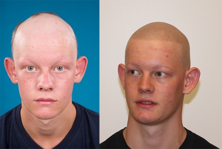 alopecia methode
