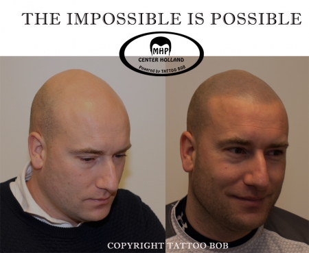 Het tatoe_???ren van de haarfollikels is een artistieke techniek voor haarsimulatie, speciaal ontwikkeld voor mannen en vrouwen met kaalheid, alopecia, dun haar of die (veel) last hebben van haaruitval. Het stadium van haaruitval is hierbij niet van belan
